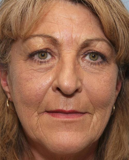 Face Lift Before & After Gallery - Patient 58490501 - Image 1