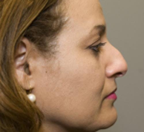 Rhinoplasty Before & After Gallery - Patient 58490500 - Image 1