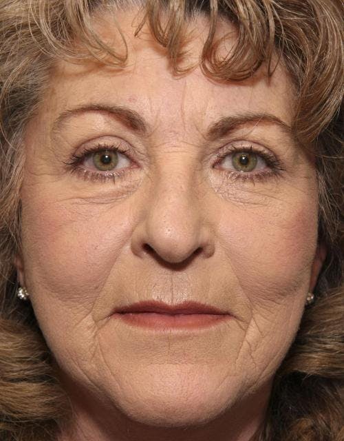 Face Lift Before & After Gallery - Patient 58490501 - Image 2