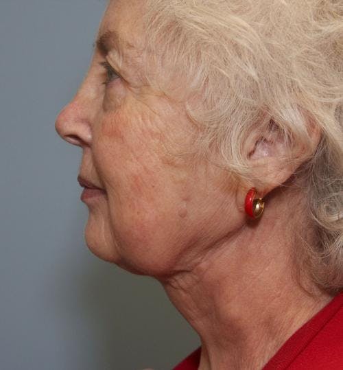 Neck Lift Before & After Gallery - Patient 58490499 - Image 2