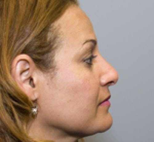 Rhinoplasty Before & After Gallery - Patient 58490500 - Image 2