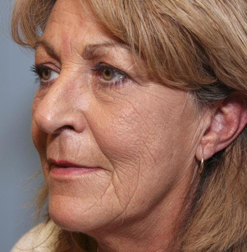 Face Lift Before & After Gallery - Patient 58490501 - Image 3