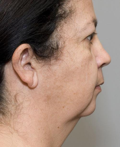 Neck Lift Before & After Gallery - Patient 58490502 - Image 1