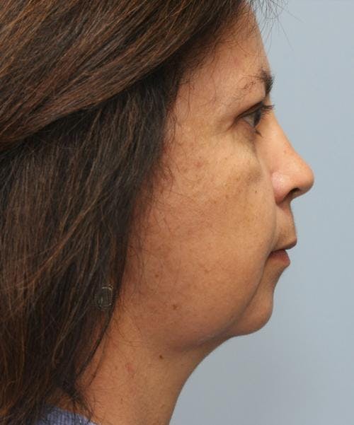 Neck Lift Before & After Gallery - Patient 58490502 - Image 2