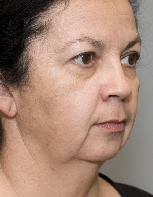 Neck Lift Before & After Gallery - Patient 58490502 - Image 3