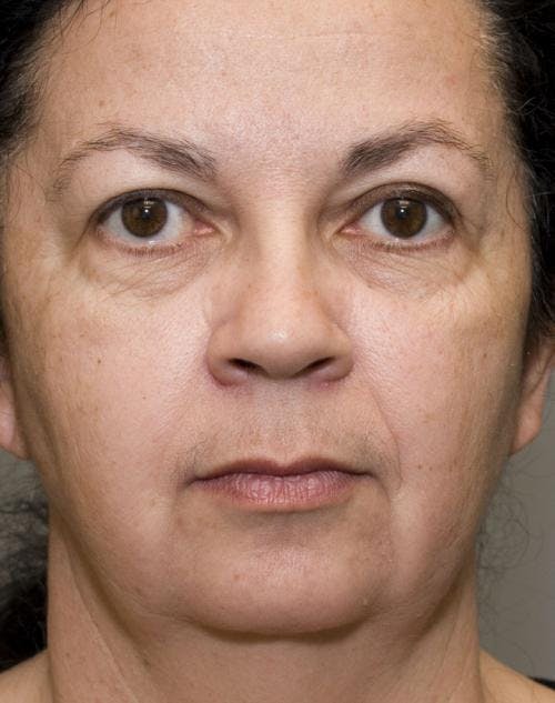 Face Lift Before & After Gallery - Patient 58490503 - Image 1