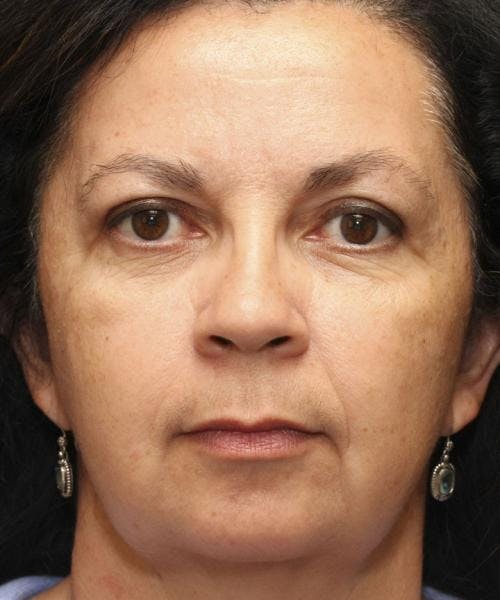 Face Lift Before & After Gallery - Patient 58490503 - Image 2