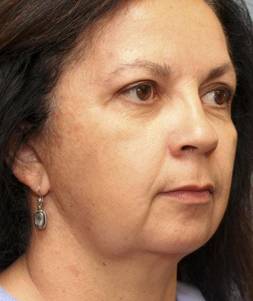 Face Lift Before & After Gallery - Patient 58490503 - Image 4