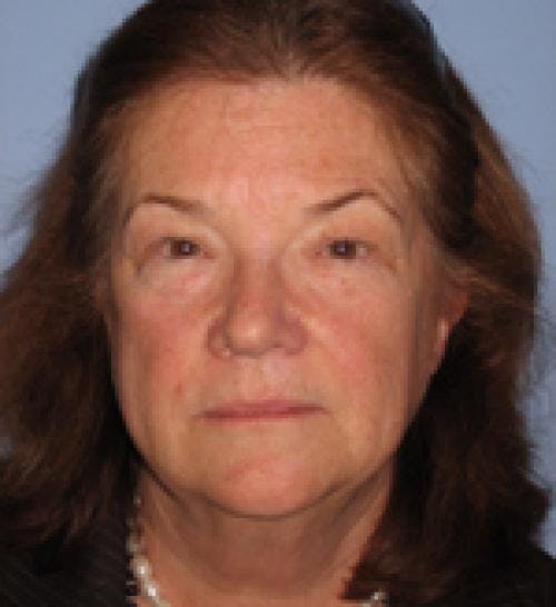 Face Lift Before & After Gallery - Patient 58490507 - Image 1