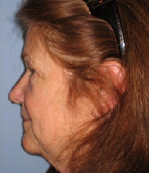 Face Lift Before & After Gallery - Patient 58490507 - Image 3