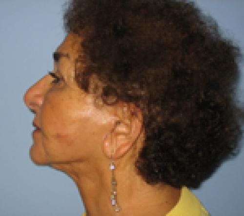 Neck Lift Before & After Gallery - Patient 58490506 - Image 2