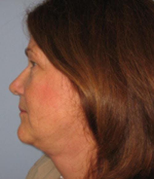 Face Lift Before & After Gallery - Patient 58490507 - Image 4