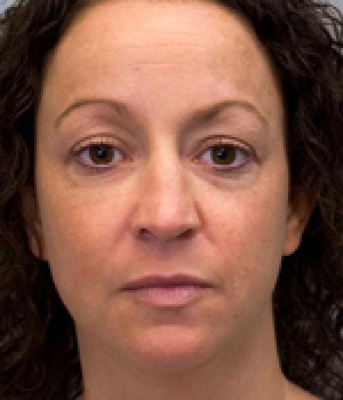 Neck Lift Before & After Gallery - Patient 58490508 - Image 3