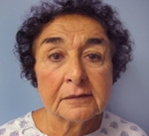 Face Lift Gallery - Patient 58490509 - Image 1