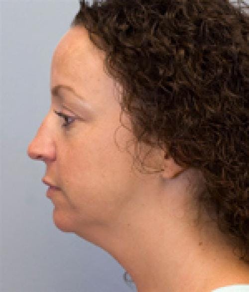 Neck Lift Before & After Gallery - Patient 58490508 - Image 1