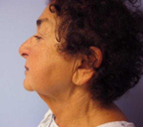 Face Lift Before & After Gallery - Patient 58490509 - Image 3