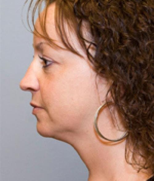 Neck Lift Before & After Gallery - Patient 58490508 - Image 2