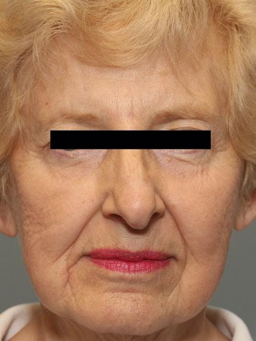 Face Lift Before & After Gallery - Patient 58490510 - Image 1