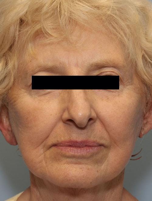 Face Lift Before & After Gallery - Patient 58490510 - Image 2