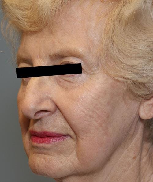 Face Lift Before & After Gallery - Patient 58490510 - Image 3