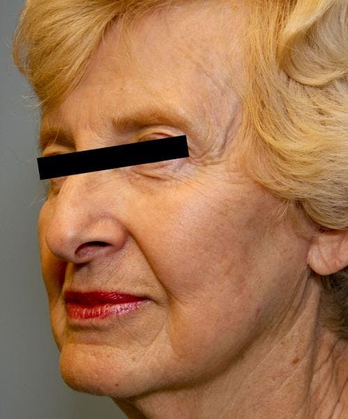 Face Lift Before & After Gallery - Patient 58490510 - Image 4