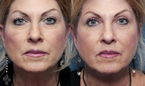 Eyelid Surgery (Upper Blepharoplasty) Before & After Gallery - Patient 58490516 - Image 1