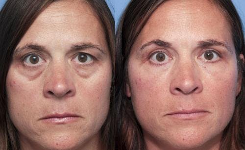 Eyelid Surgery (Blepharoplasty) Before & After Gallery - Patient 58490517 - Image 1