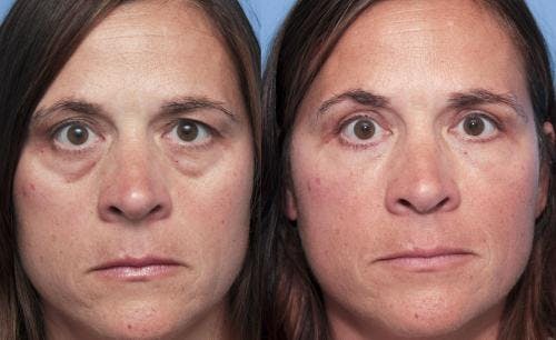 Eyelid Surgery (Upper & Lower Blepharoplasty) Before & After Gallery - Patient 563537 - Image 1