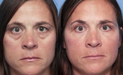 Eyelid Surgery (Upper & Lower Blepharoplasty) Before & After Gallery - Patient 563537 - Image 1