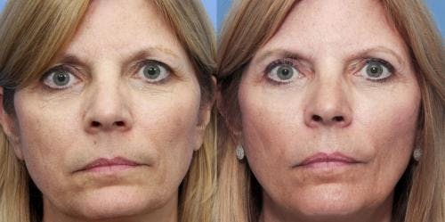 Eyelid Surgery (Blepharoplasty) Before & After Gallery - Patient 58490520 - Image 1