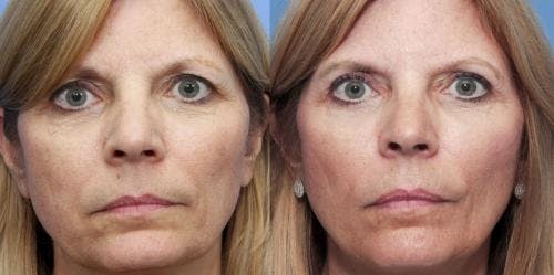 Eyelid Surgery (Upper Blepharoplasty) Before & After Gallery - Patient 58490520 - Image 1