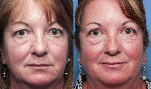 Eyelid Surgery (Upper Blepharoplasty) Before & After Gallery - Patient 58490521 - Image 1