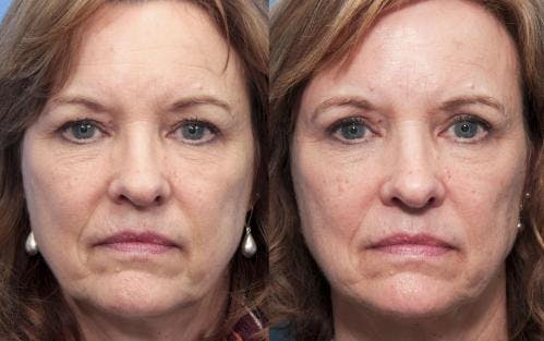 Eyelid Surgery (Blepharoplasty) Before & After Gallery - Patient 58490522 - Image 1