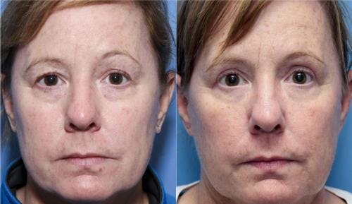 Eyelid Surgery (Blepharoplasty) Before & After Gallery - Patient 58490523 - Image 1