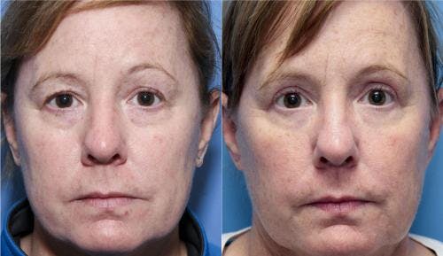 Eyelid Surgery (Upper Blepharoplasty) Before & After Gallery - Patient 58490523 - Image 1