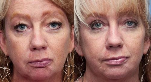 Eyelid Surgery (Blepharoplasty) Before & After Gallery - Patient 58490524 - Image 1