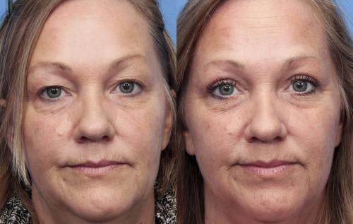Eyelid Surgery (Upper Blepharoplasty) Before & After Gallery - Patient 58490527 - Image 1