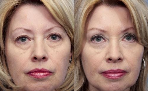 Eyelid Surgery (Blepharoplasty) Before & After Gallery - Patient 58490529 - Image 1