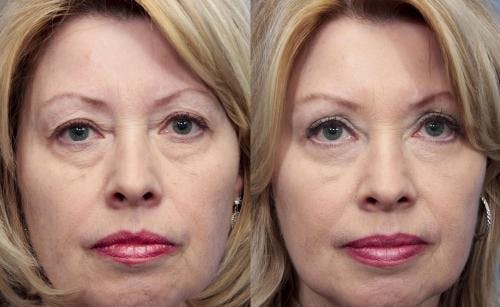 Eyelid Surgery (Upper & Lower Blepharoplasty) Before & After Gallery - Patient 113791 - Image 1