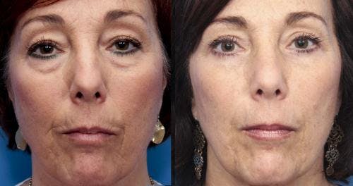 Fat Grafting Before & After Gallery - Patient 58490532 - Image 1