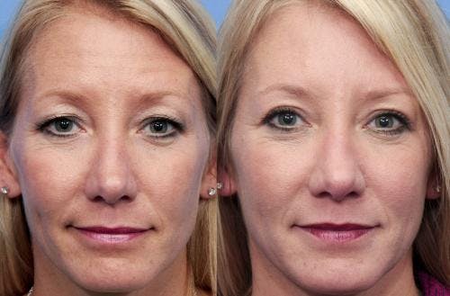 Eyelid Surgery (Blepharoplasty) Before & After Gallery - Patient 58490531 - Image 1