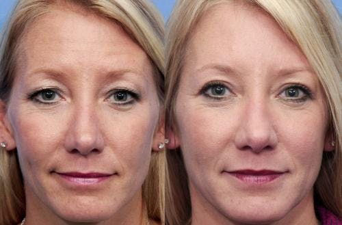 Eyelid Surgery (Upper Blepharoplasty) Before & After Gallery - Patient 58490531 - Image 1