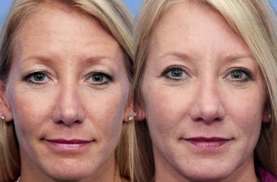 Eyelid Surgery (Upper Blepharoplasty) Before & After Gallery - Patient 58490531 - Image 1