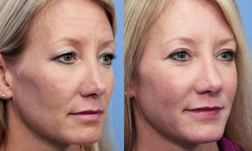Eyelid Surgery (Upper Blepharoplasty) Before & After Gallery - Patient 58490531 - Image 2