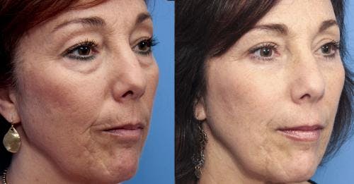 Fat Grafting Before & After Gallery - Patient 58490532 - Image 2