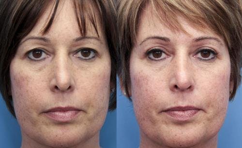 Eyelid Surgery (Blepharoplasty) Before & After Gallery - Patient 58490533 - Image 1