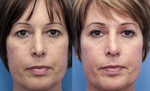 Eyelid Surgery (Upper Blepharoplasty) Before & After Gallery - Patient 58490533 - Image 1