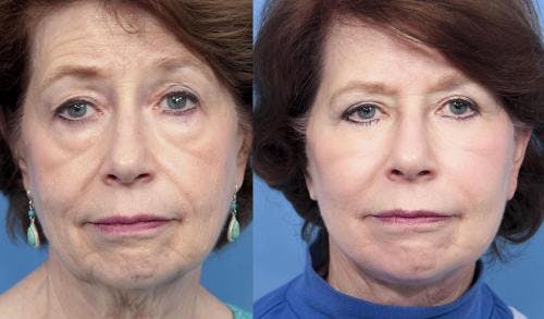 Fat Grafting Before & After Gallery - Patient 58490535 - Image 1