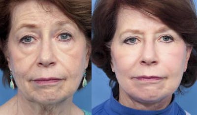 Fat Grafting Before & After Gallery - Patient 58490535 - Image 1
