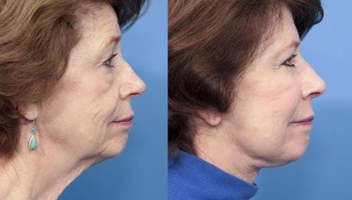 Fat Grafting Before & After Gallery - Patient 58490535 - Image 2